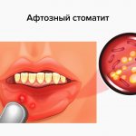 Aphthous stomatitis in pictures