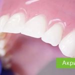 Acrylic dentures