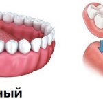 Альтернативы имплантации