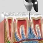 When injected, the anesthetic does not enter the bloodstream.