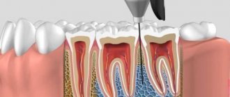 When injected, the anesthetic does not enter the bloodstream.