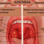 How to treat sore throat and stomatitis at the same time in a child