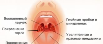 sore throat symptoms