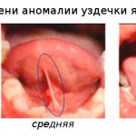 Abnormal degrees of frenulum in a child and indications for trimming