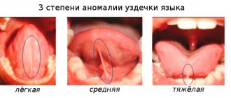 Abnormal degrees of frenulum in a child and indications for trimming