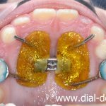 Marco Rosa apparatus for maxillary expansion