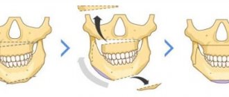 Asymmetry of the lower jaw