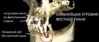 Атрофия костной ткани при сахарном диабете. Пациент Немецкого имплантологического центра. Лечащий врач - Дахкильгов Магомед Уматгиреевич