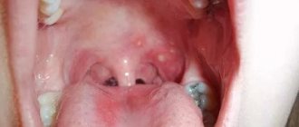 White pimples in throat