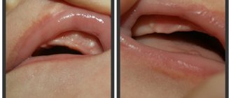 white spots and spots on the gums of infants