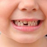 Don&#39;t panic! A child’s baby tooth falls out, but the root remains - what to do? 