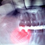 Pain due to wisdom tooth cutting - Smile Line Dentistry