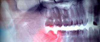 Pain due to wisdom tooth cutting - Smile Line Dentistry