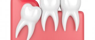 Painful symptoms from wisdom teeth