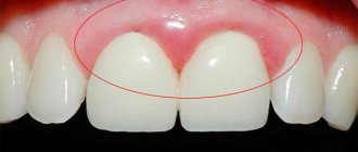 Болит передний верхний зуб