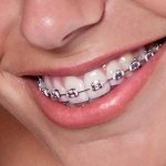 Braces