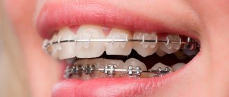 Braces