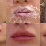 How to smear lips after lip augmentation with hyaluronic acid?