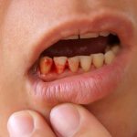 What to do if your gums bleed constantly