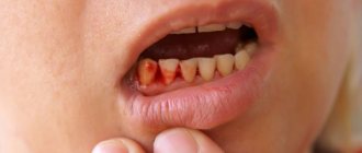 What to do if your gums bleed constantly