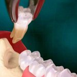 What to do after tooth extraction