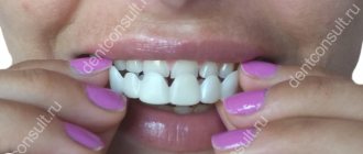 What are removable veneers