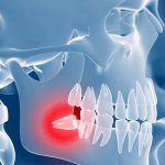 What is complex wisdom tooth extraction?