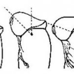 Deformation of the penis with a short frenulum