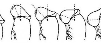 Deformation of the penis with a short frenulum