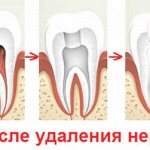 Депульпирование зуба протезирование