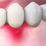 Gums hurt between teeth