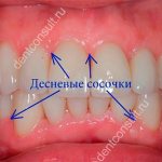 Gingival papillae