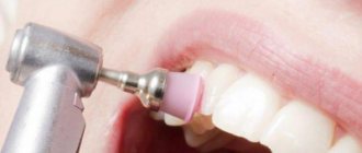 photo used for polishing teeth