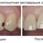 Before and after composite dental restoration