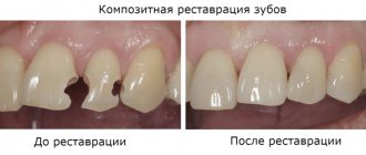 Before and after composite dental restoration