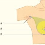 Access for placing implants