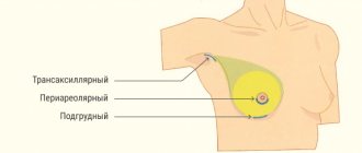 Access for placing implants