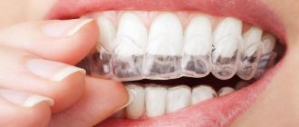 Aligners