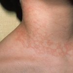 Erythema