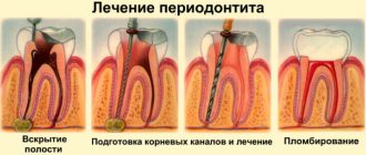 Stages of root canal treatment for dental periodontitis