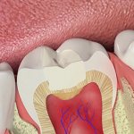 stages of tooth filling