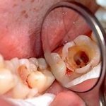 Fibrous pulpitis