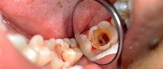 Fibrous pulpitis