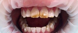 Fluorosis