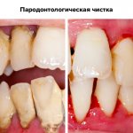 Фото до и после пародонтологической чистки