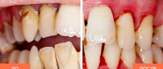 Photos before and after periodontal cleaning