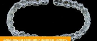 Photos of aligners for the upper and lower jaw