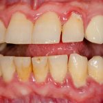 Photo of gingivitis