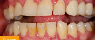 Photo of gingivitis