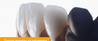 Photo of thin ceramic veneers on a dental model